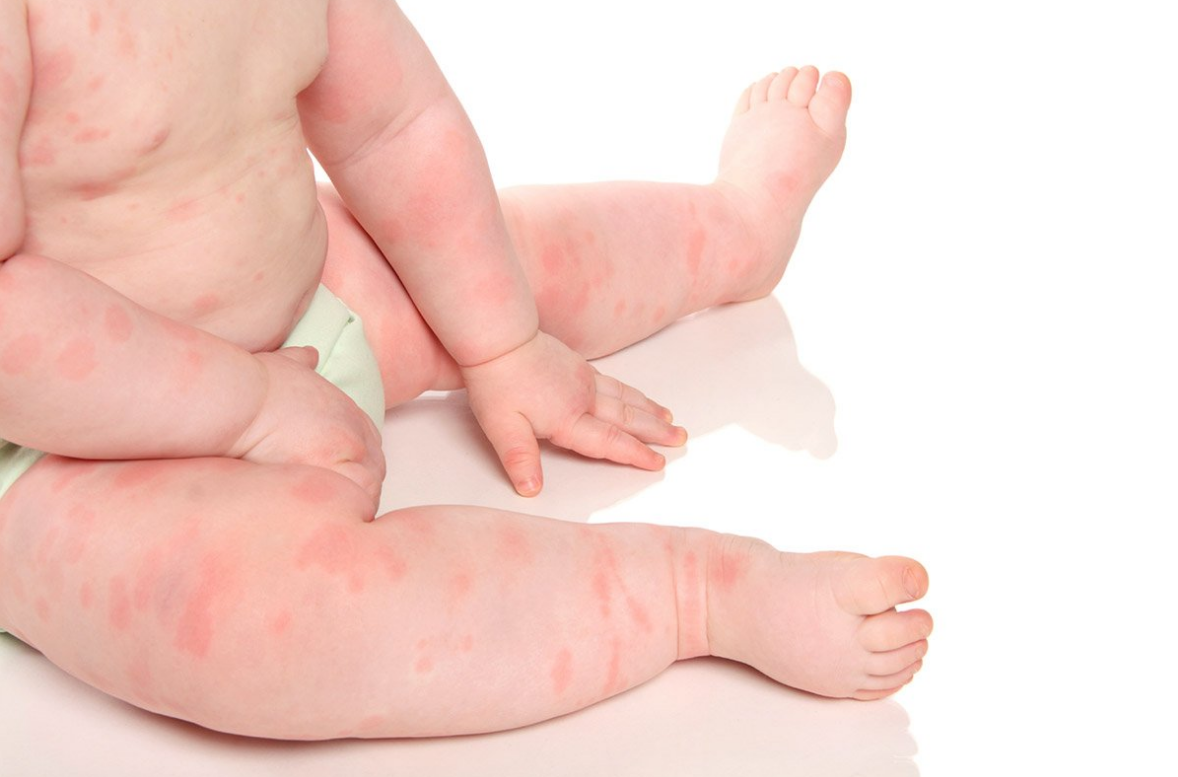 Аллергия у детей: на что бывает, основные аллергены у детей — Fenkarol®