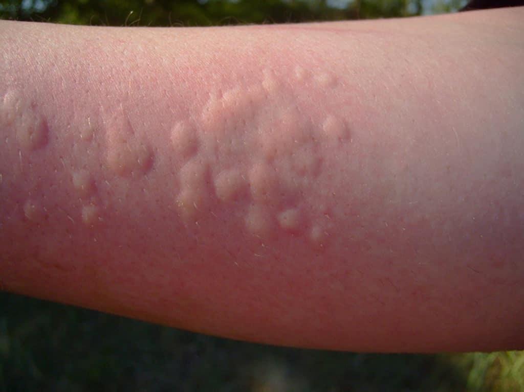 Высыпания на коже при лекарственной аллергии