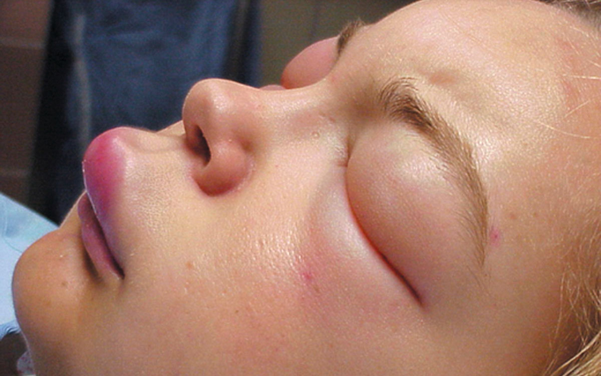 На лице сыпь: причины появления, заболевания и аллергические и угревые высыпания на коже, лечение