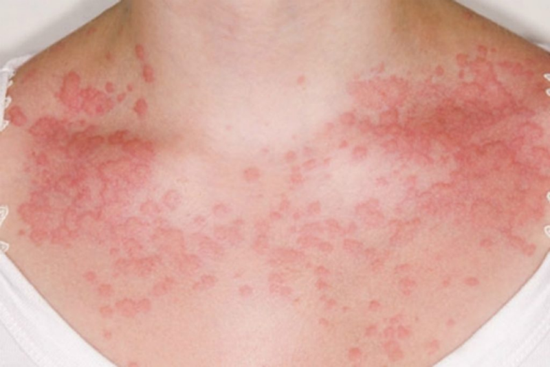 Аллергия на лице лечение, что делать когда на лице высыпания — Fenkarol®