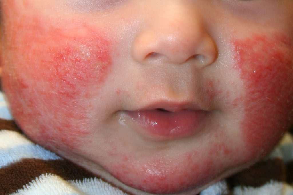 Аллергическая сыпь у детей. Основные критерии: