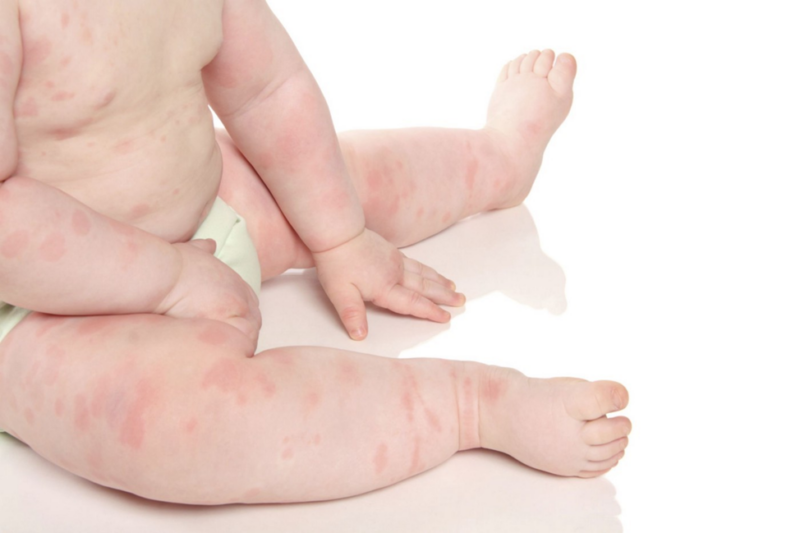 У грудного ребенка пищевая аллергия. Что делать?