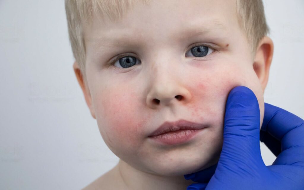 аллергия на сладкое у детей