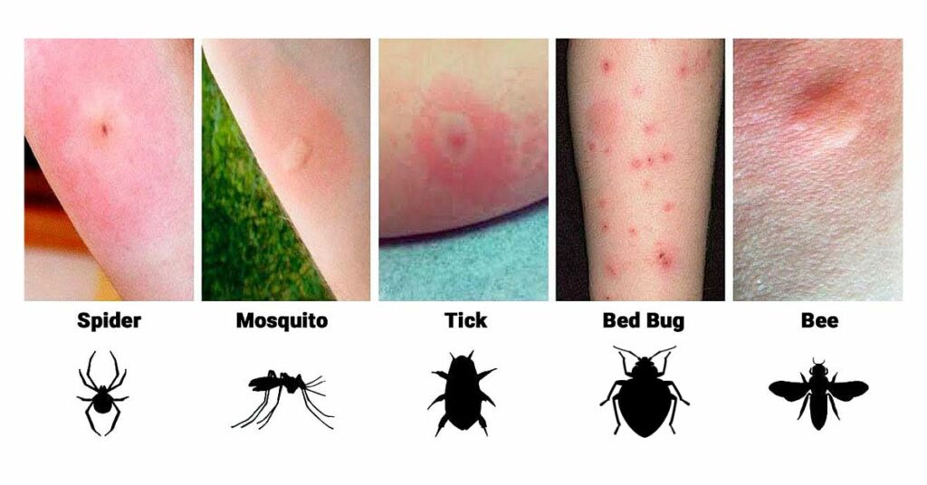 Аллергия на укусы насекомых у ребенка