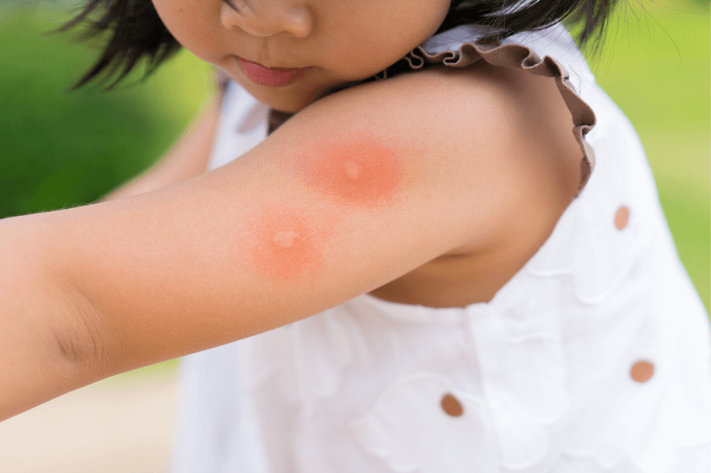 аллергическая реакция на комариные укусы